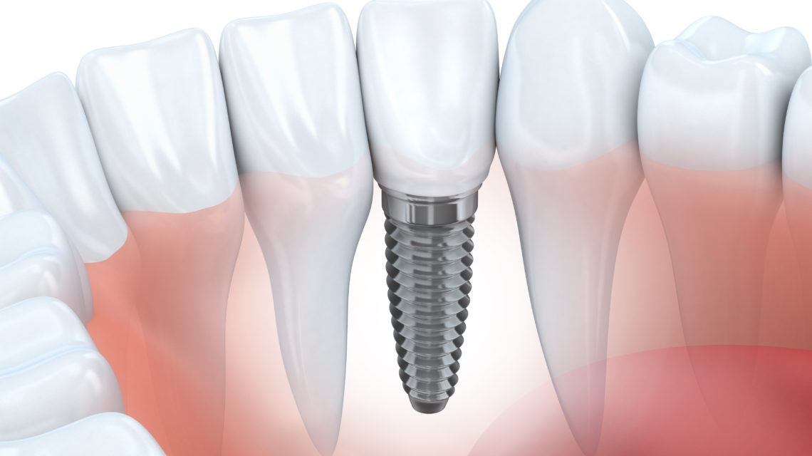 Dental Implants Example
